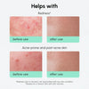 Redness Soothing Azelaic Acid Serum
