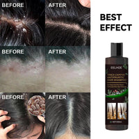 EELHOE Anti-Dandruff Shampoo - Itch Relief, Hair Loss Prevention, Oil Control & Refreshing Care EasyOptionXY LLC